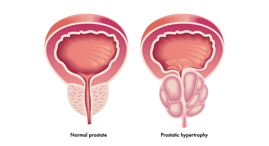 İyi Huylu Prostat Büyümesi İçin Bilgilendirme