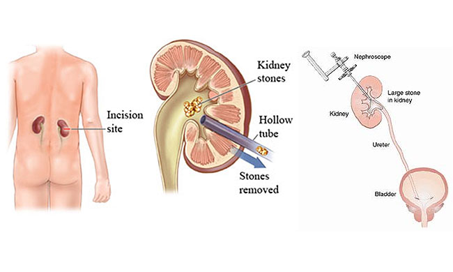 Böbrek ve Üreter Taşları