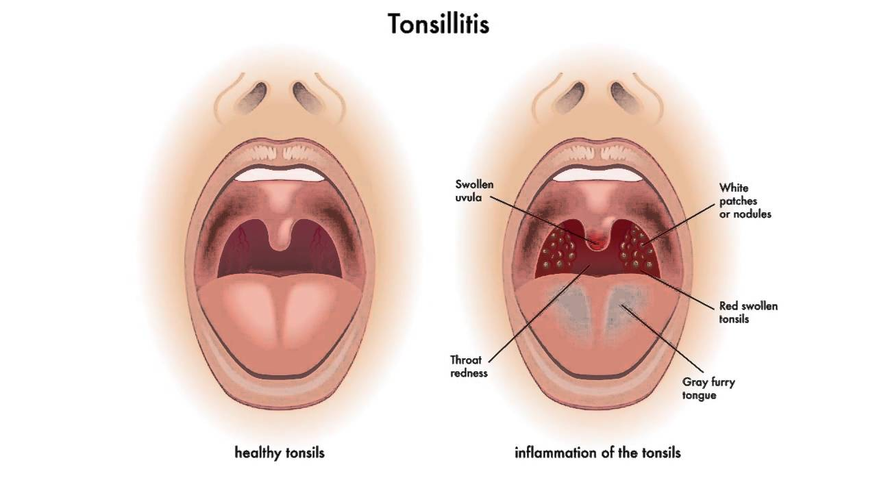 Bademcik Taşı (Tonsillit)