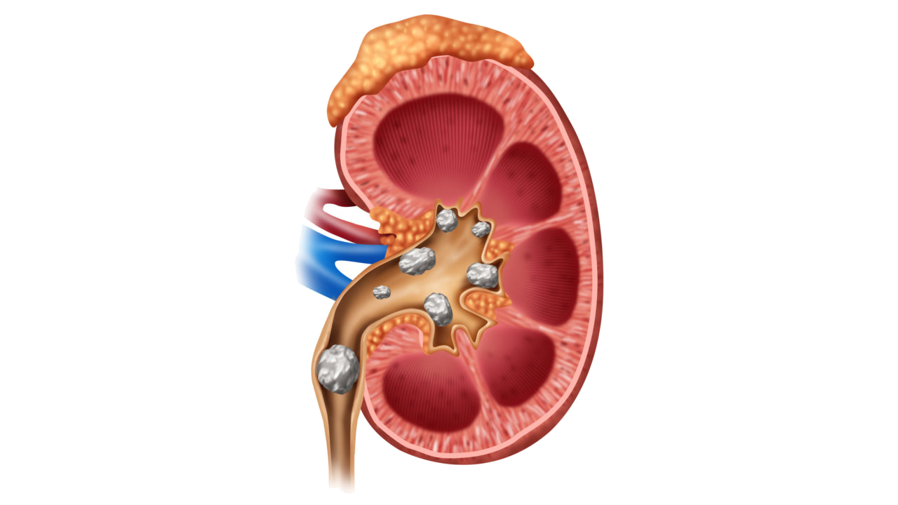 Böbrek Taşı Nedir?