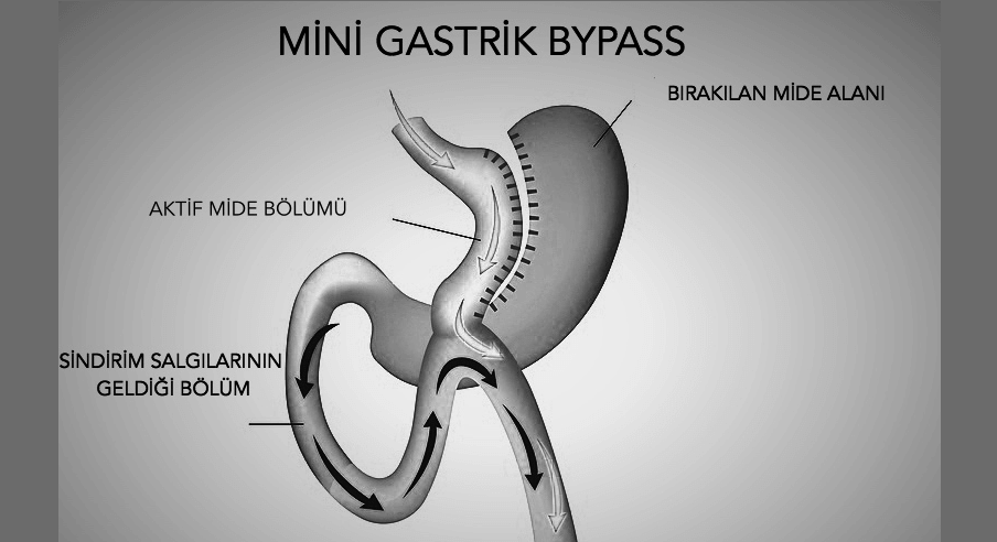 Mini Gastrik Bypass