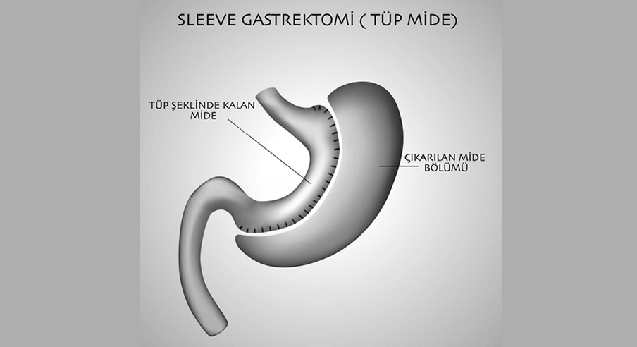 Tüp Mide Ameliyatı (Sleeve Gastrektomi)